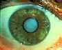 Photo of eye with advanced cataract