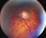 Optic Nerve showing glaucomatous damage