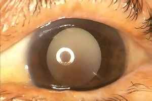 Photo of a Morgagnian cataract